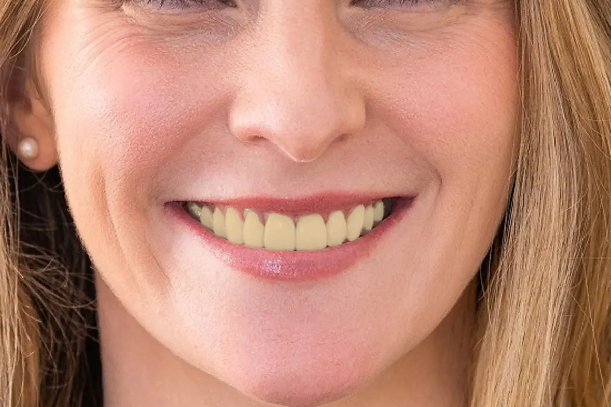 Simulación de ejemplo: sonrisa antes de un blanqueamiento dental, con los dientes más amarillos