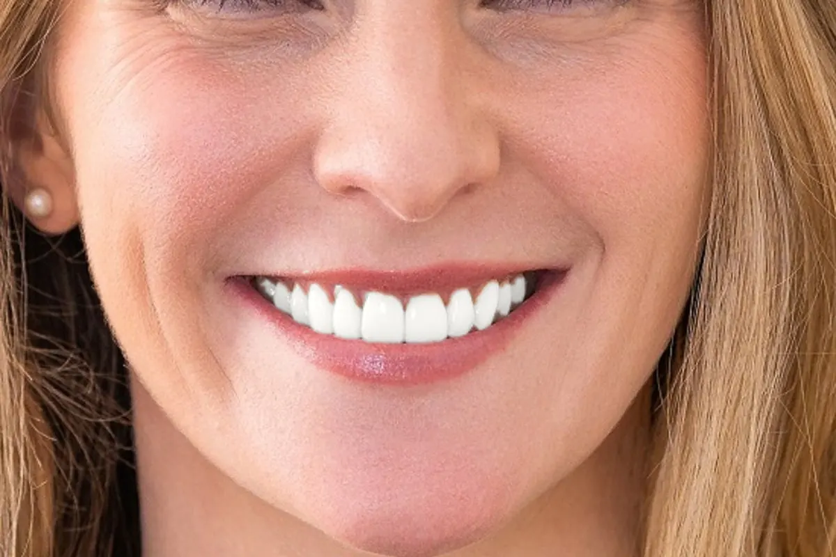 Simulación de ejemplo: la misma sonrisa después de un blanqueamiento dental, con los dientes más claros