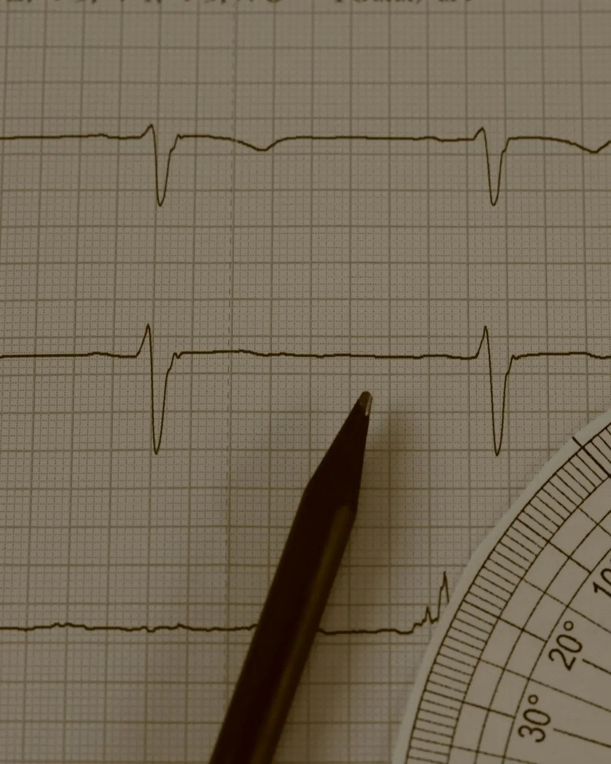 Trazado de un electrocardiograma en papel con un lápiz y un transportador