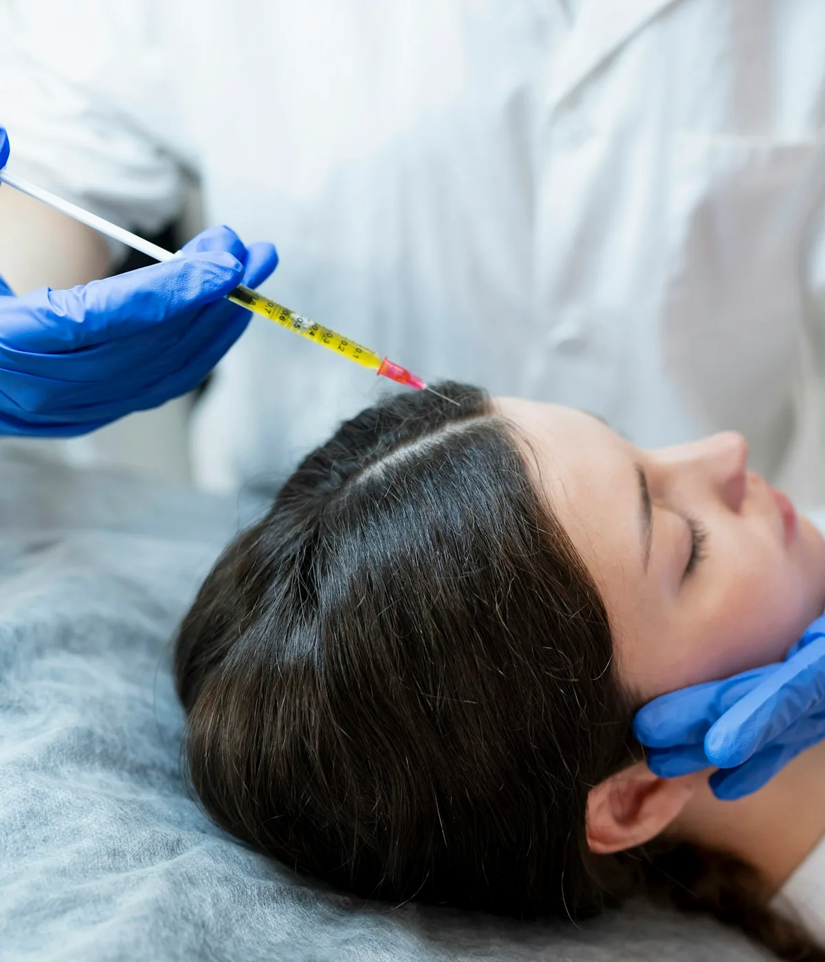 Médica aplicando microinyecciones de mesoterapia en el cuero cabelludo de un paciente en la clínica capilar de Murcia