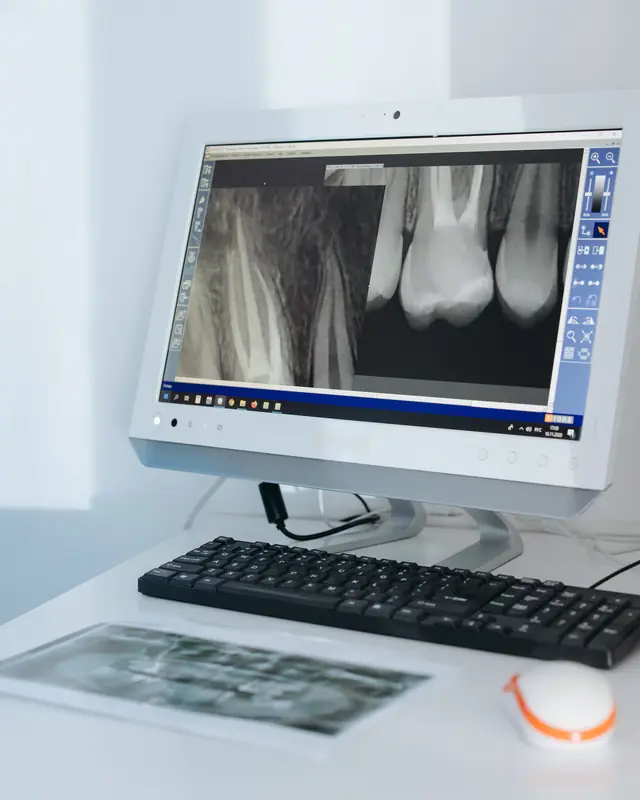Radiografía de una muela en la pantalla de la consulta antes de una endodoncia