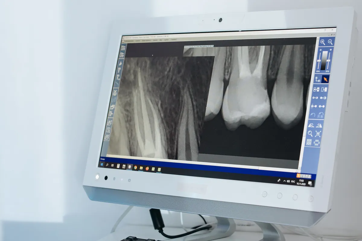 Radiografía dental digital de unos molares en el monitor de la clínica